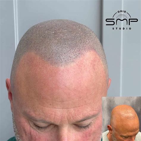 Scalp Micropigmentation vs. Microblading .